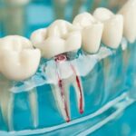 The Root Canal Process: What to Expect Before, During, and After