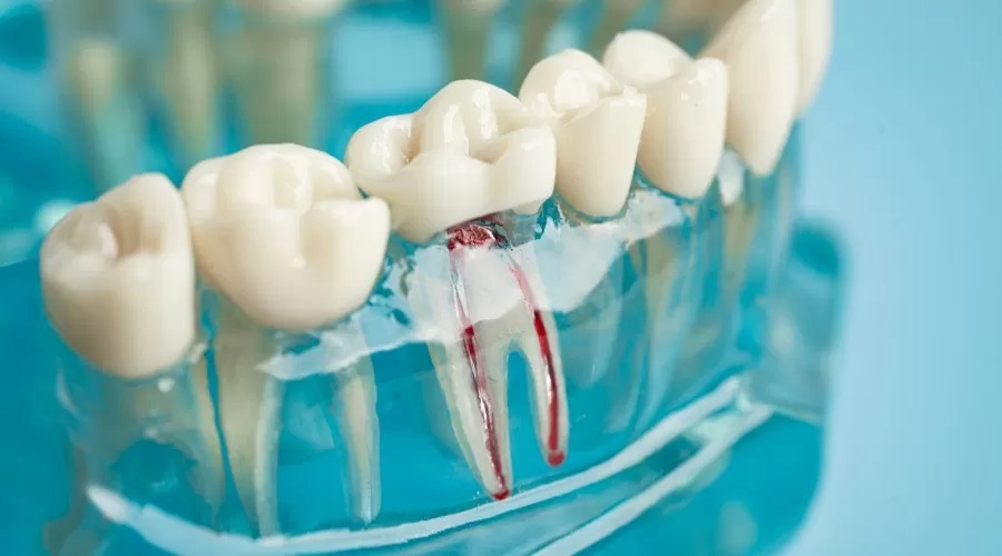 The Root Canal Process: What to Expect Before, During, and After