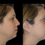 Top Celebrity-Inspired Looks Using Double chin removal Surgery in dubai