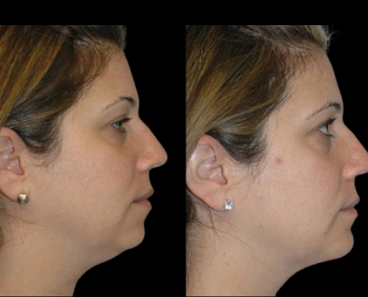 Top Celebrity-Inspired Looks Using Double chin removal Surgery in dubai
