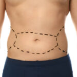 Discover the Advantages of Tummy Tuck Surgery in Islamabad