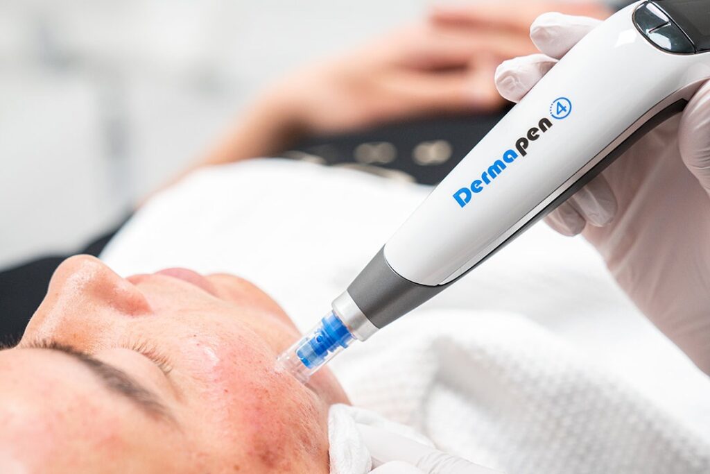 Step-by-Step Guide to Dermapen Treatment in Islamabad