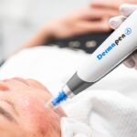 Step-by-Step Guide to Dermapen Treatment in Islamabad