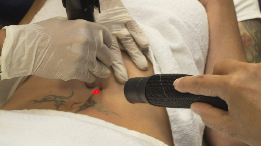 Picosure Tattoo Removal In Islamabad: Expert Dermatologists’ Advice