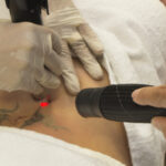 Picosure Tattoo Removal In Islamabad: Expert Dermatologists’ Advice