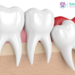 Is Wisdom Tooth Removal a Minor or Major Surgery?
