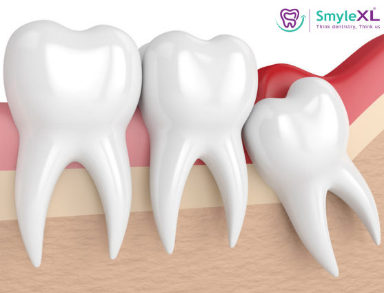 Is Wisdom Tooth Removal a Minor or Major Surgery?