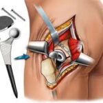 Risks and Complications of Hip Replacement Surgery