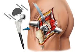 Risks and Complications of Hip Replacement Surgery