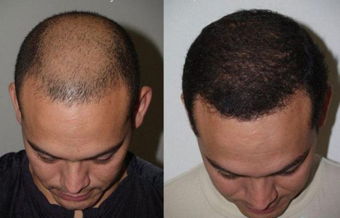 متى تظهر النتائج النهائية بعد زراعة الشعر في دبي؟ الجدول الزمني الكامل