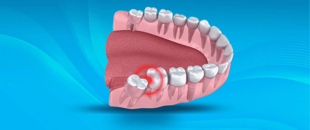 Wisdom Tooth Removal: The Relief Your Smile Needs