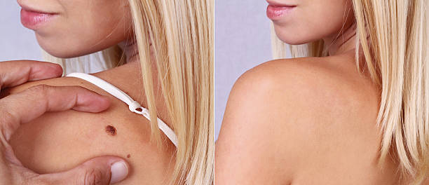 Best Methods for Painless Warts Removal in Islamabad