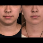 Best Time to Schedule Double chin removal Surgery in dubai