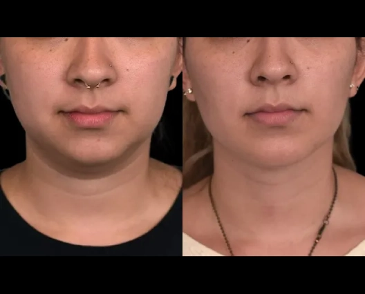 Best Time to Schedule Double chin removal Surgery in dubai