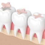 How Tooth Colored Fillings Help Repair Decayed Teeth