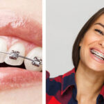 Top Benefits of Braces Treatment Beyond a Straighter Smile