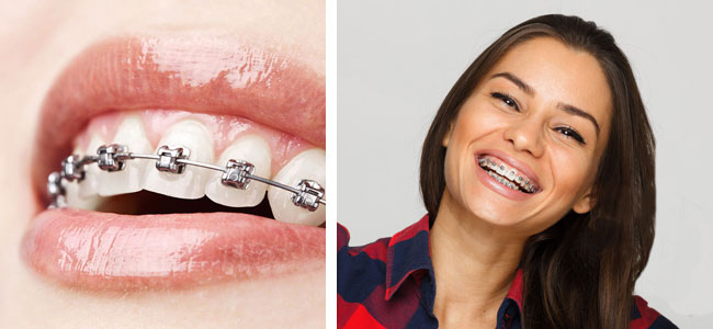 Top Benefits of Braces Treatment Beyond a Straighter Smile