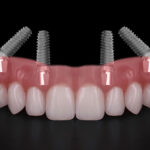 How Tooth Replacement Helps Prevent Bone Loss and Shifting Teeth