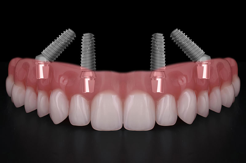 How Tooth Replacement Helps Prevent Bone Loss and Shifting Teeth