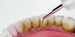 How Much Does Teeth Cleaning Cost in 2026?