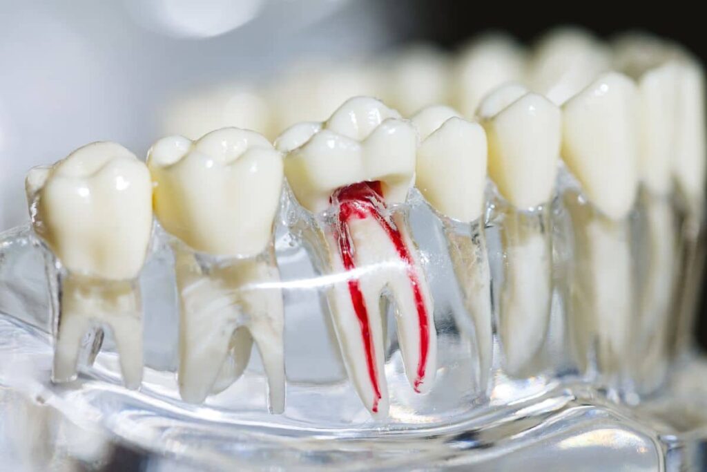 7 Signs You Might Need Root Canal Treatment