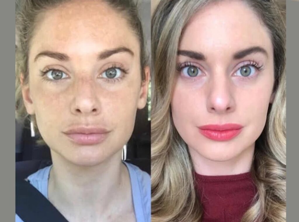 Firm and Lifted Skin Using Radiofrequency (RF) Microneedling by the Best Aesthetic Clinic in Dubai