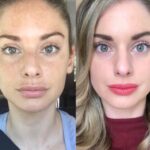 Firm and Lifted Skin Using Radiofrequency (RF) Microneedling by the Best Aesthetic Clinic in Dubai