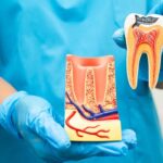 Is Single Sitting RCT Safe and Effective? Everything You Need to Know