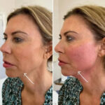 Best Aesthetic Clinics in Dubai Offering Non-Surgical Endolift Rejuvenation