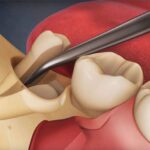 Common Problems Caused by Impacted Wisdom Teeth