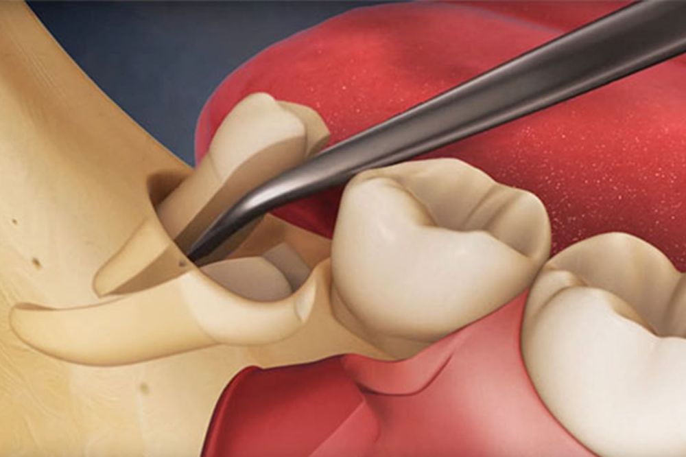 Common Problems Caused by Impacted Wisdom Teeth