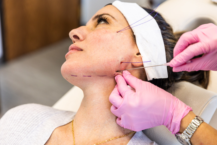 How Long Do Results of Thread Lift in London Last?