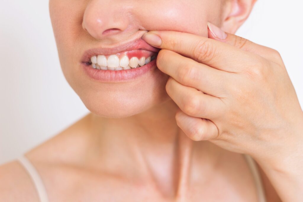 Why Prompt Treatment for Bleeding Gums Is Important in Badlapur Residents