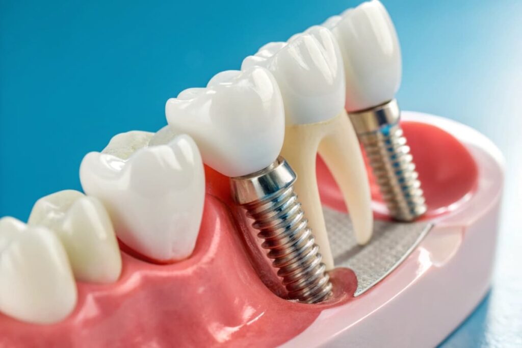 How Long Do Dental Implants Last? Facts You Should Know