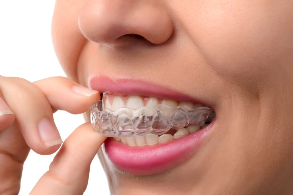 Thinking About Invisalign? What Mumbai Professionals Know Before Starting Treatment