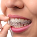 Thinking About Invisalign? What Mumbai Professionals Know Before Starting Treatment