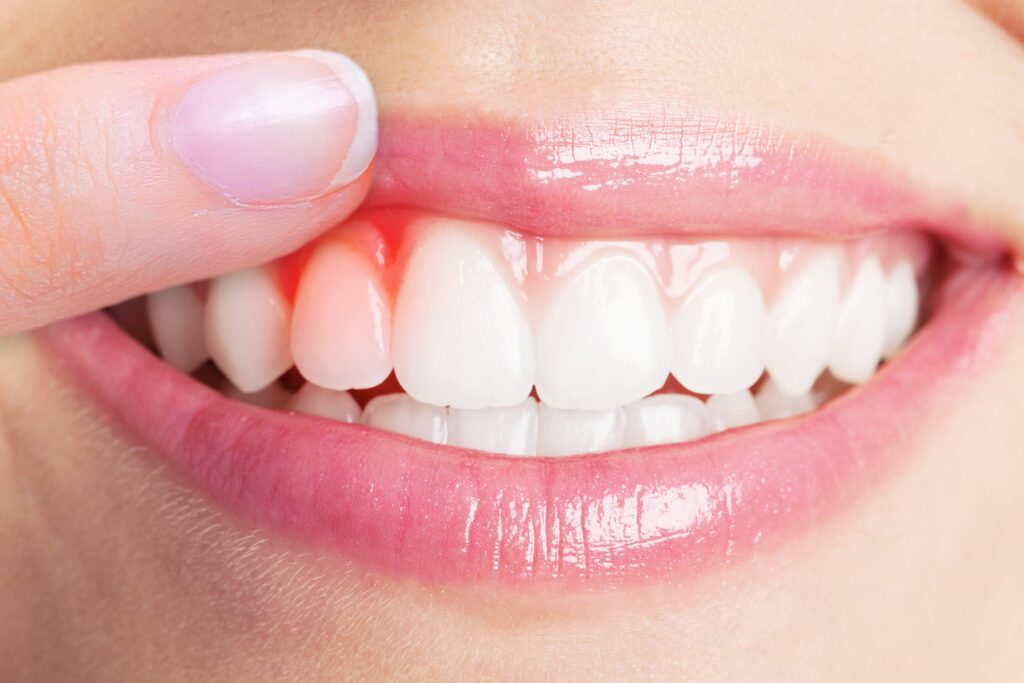 Gum Treatment in Prashant Vihar: Understanding Gingivitis and Periodontitis