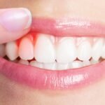 Gum Treatment in Prashant Vihar: Understanding Gingivitis and Periodontitis