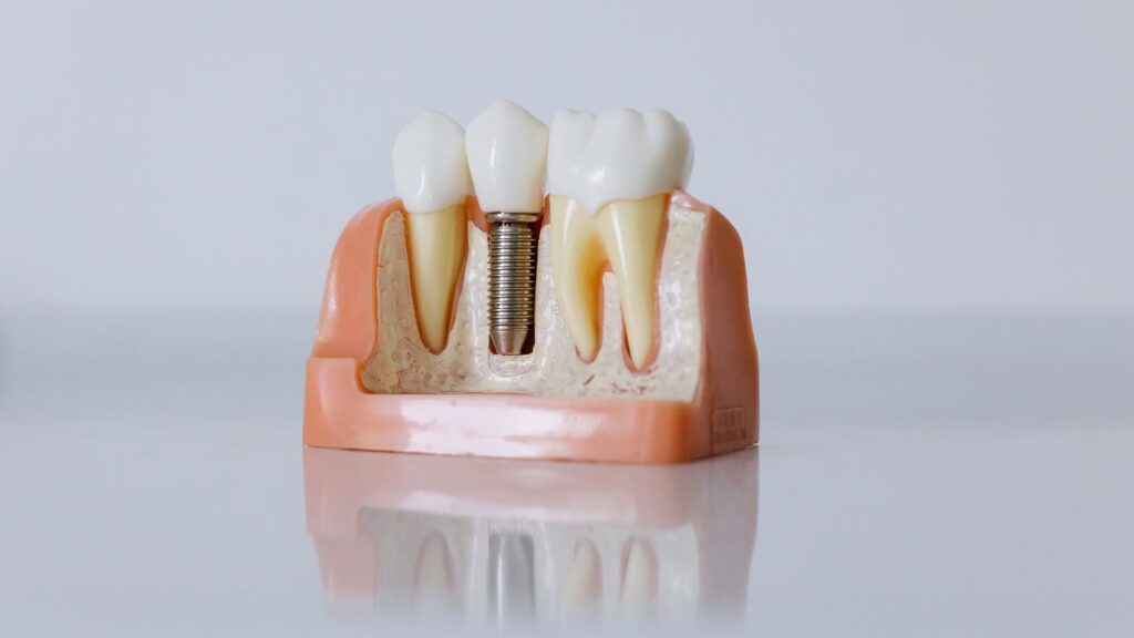 Can Dental Implants Help Prevent Teeth Shifting After Tooth Loss?