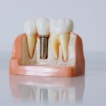 Can Dental Implants Help Prevent Teeth Shifting After Tooth Loss?