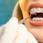 Oral Care Tips During Orthodontic Treatment