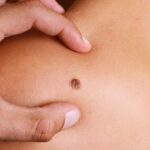 Early Signs of Skin Cancer Every Orlando Resident Should Watch For