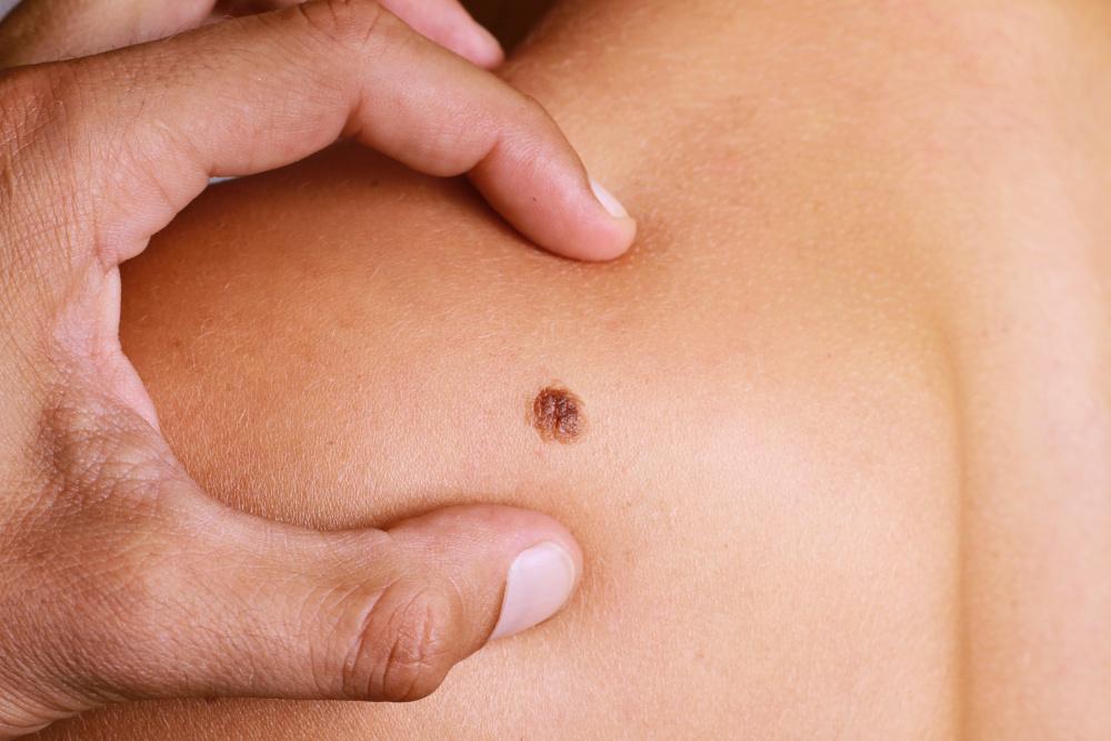 Early Signs of Skin Cancer Every Orlando Resident Should Watch For