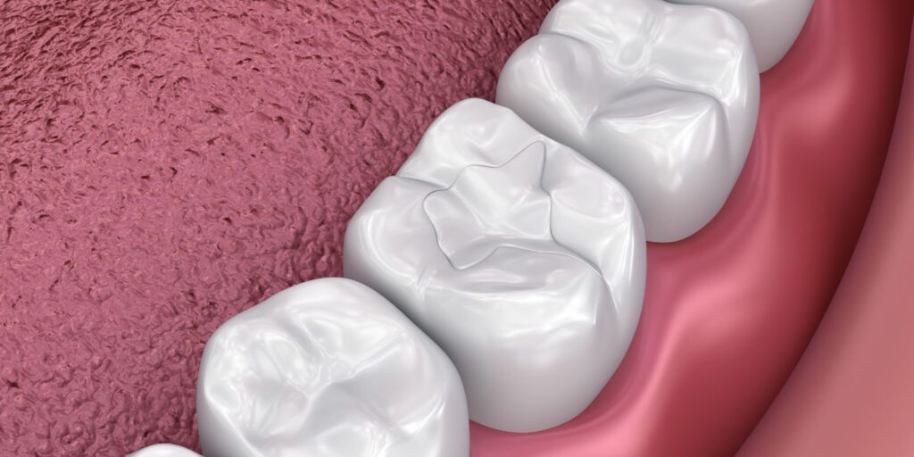 Can Dental Sealants Improve Your Child’s Oral Health Outcomes?
