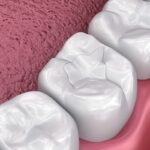 Can Dental Sealants Improve Your Child’s Oral Health Outcomes?