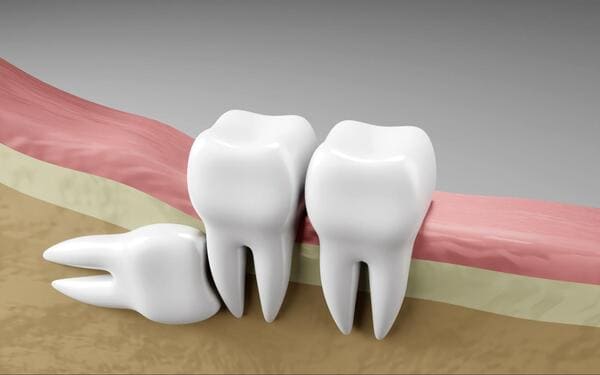 How Long Does It Take to Recover from Tooth Extraction?