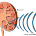 Lithotripsy Treatment: A Modern Approach to Kidney Stone Removal