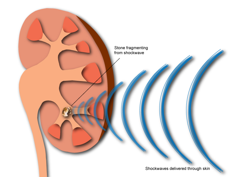 Lithotripsy Treatment: A Modern Approach to Kidney Stone Removal