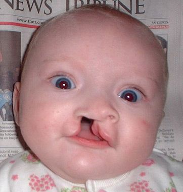 Congenital Anomalies in Dubai: Essential Pediatric Support