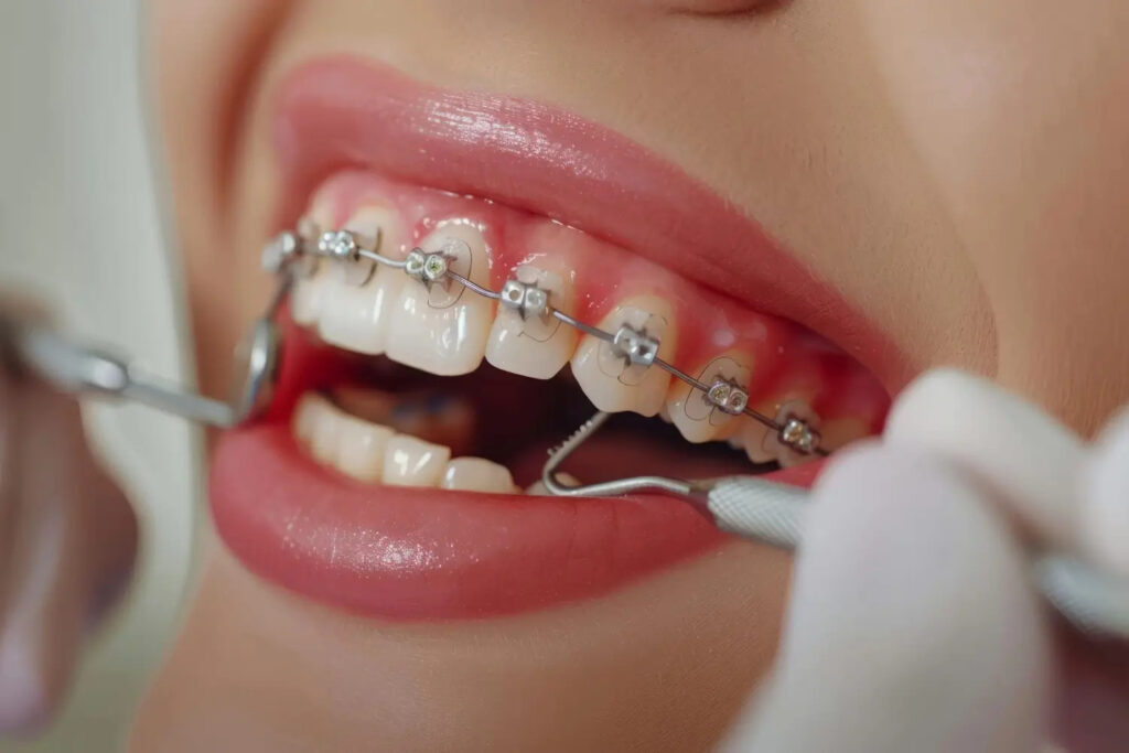 Thinking About Braces as an Adult? Here’s What You Should Know